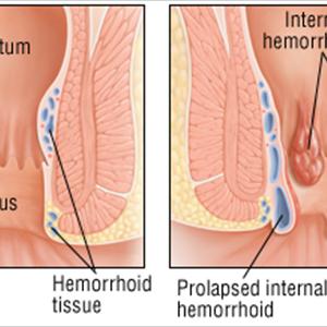 Herbal Remedies For Hemroids - Hemorrhoid Treatment To Relieve You Of Your Symptoms