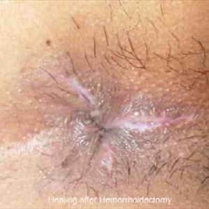 Pictures Of Thrombosed Hemorrhoids - Neo Healar - A Natural Hemorrhoid Cure