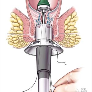 Bleeding Hemorrhoids During Pregnancy - Hemorrhoid Herbal Treatment - Hemorrhoids Creams - Internal Hemorrhoid Cure