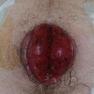 Hemorrhoid Scar - Best Hemorrhoid Treatment