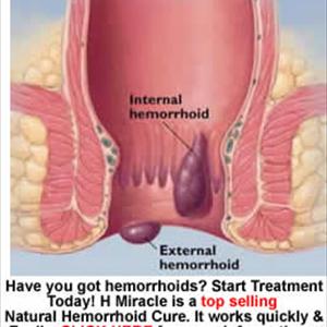 A Cure For Hemroids - Hemorrhoid Miracle Scam