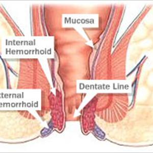 Hemorrhoids Symptom - Hemorrhoid Treatment - How To Stop Hemorrhoid Pain Fast