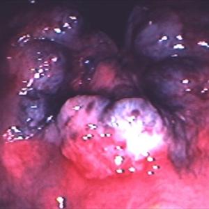 Hemroids During Pregnancy - External Hemorrhoid Treatment - Taming The External Bleeding 