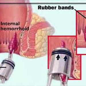 Popping A Hemorrhoid - Bleeding Hemorrhoids Treatment - Recent Procedure To Cure Hemorrhoid