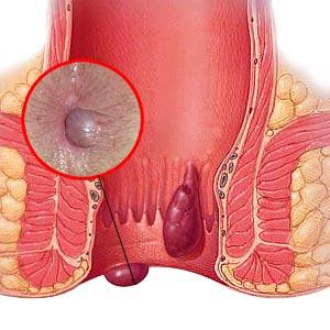 Severe Hemorrhoid Pain - Simple Hemorrhoid Treatment