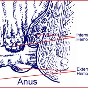 Hemorrhoid Itch - Herbs For Hemorrhoids