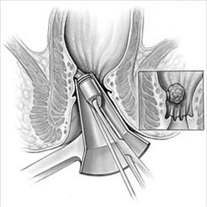 Painful Internal Hemroids - Choose A Hemorrhoid Treatment That