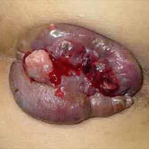 Sitz Bath Hemorrhoids - Thrombosis Hemorrhoid - Hemoroid Remedy - Pph Hemorrhoids
