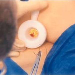 Internal Hemorrhoid Symptoms - Treat Hemorrhoid - 5 Safe Treatments For Embarrassing Hemorrhoids